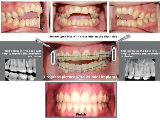 open bite correction with mini implant temporary anchorage device Tads